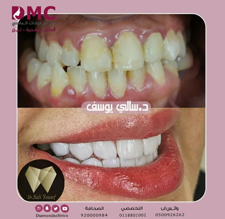 Comfort Fit Flexible Teeth     أسنان مرنة مريحة